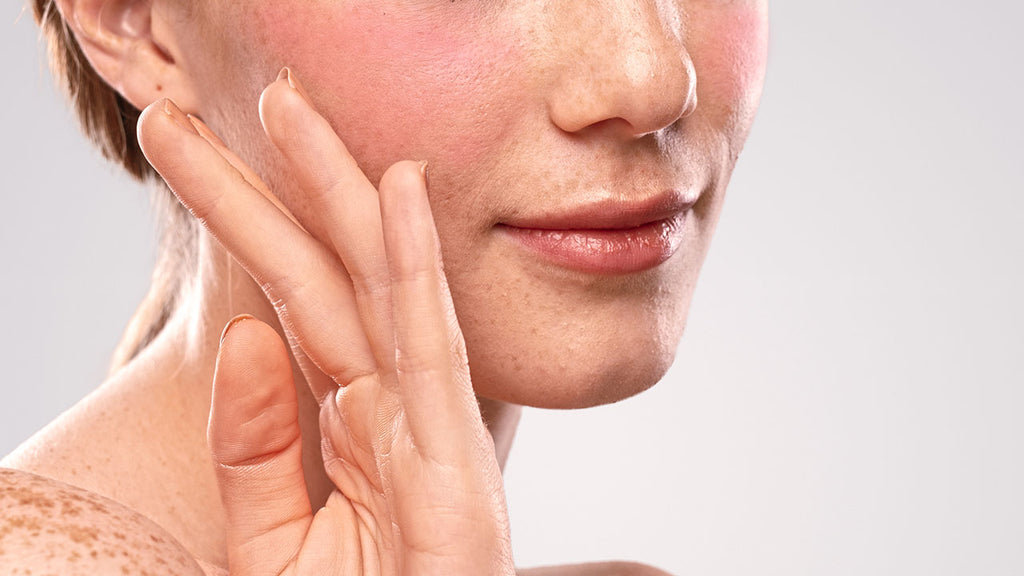 Rosácea no rosto: você sabia que o seu shampoo pode agravar o quadro?